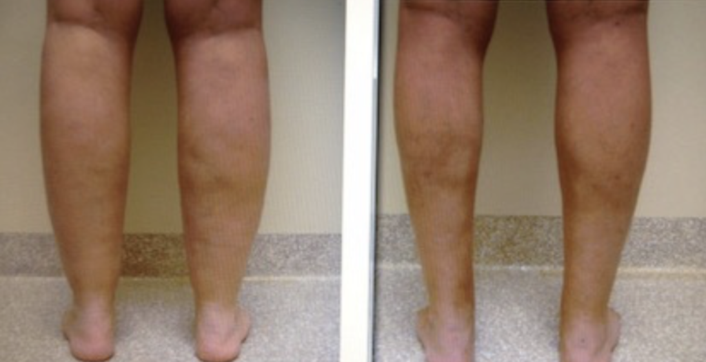 3 months post op External Ultrasonic Lipo and MPX Smartlipo Ankles